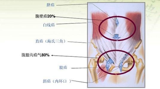 腹股沟正确位置图片图片